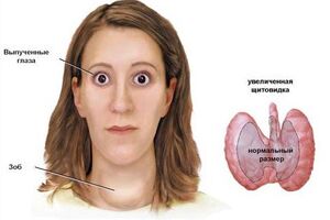 Диффузный токсический зоб: причины возникновения и основные симптомы, способы лечения заболевания