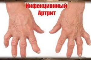 Инфекционный артрит: причины возникновения и основные симптомы, способы лечения заболевания