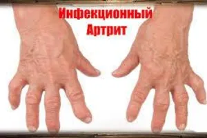 буду ориентироваться артрит инфекционного происхождения молодец, вот только