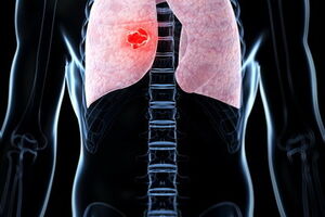 Интерстициальная пневмония: причины возникновения и основные симптомы, способы лечения заболевания