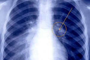 Долевая пневмония: причины возникновения и основные симптомы, способы лечения заболевания
