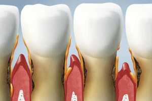 Маргинальный периодонтит: причины возникновения и основные симптомы, способы лечения заболевания