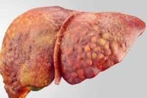 Жировой гепатоз: причини виникнення та основні симптоми, способи лікування захворювання