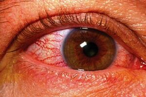 Ишемическая нейропатия зрительного нерва: причини виникнення та основні симптоми, способи лікування захворювання