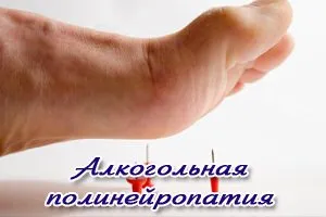Алкогольная полинейропатия: причины возникновения и основные симптомы, способы лечения заболевания
