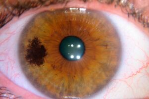 Меланома глаза: причини виникнення та основні симптоми, способи лікування захворювання