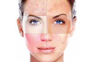 Комбинированная кожа: причини виникнення та основні симптоми, способи лікування захворювання