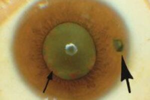 Металлоз глаза: причини виникнення та основні симптоми, способи лікування захворювання