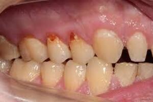 Компьютерный некроз зубов: причини виникнення та основні симптоми, способи лікування захворювання