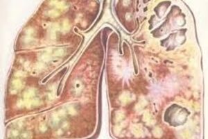 Кавернозный туберкулез легких: причины возникновения и основные симптомы, способы лечения заболевания