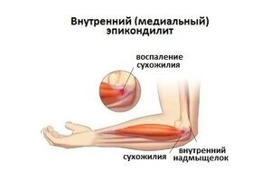 Медиальный эпикондилит: причини виникнення та основні симптоми, способи лікування захворювання