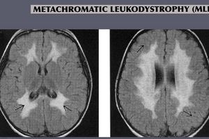 Метахроматическая лейкодистрофия: причины возникновения и основные симптомы, способы лечения заболевания