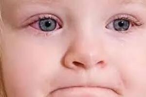Конъюнктивит у детей: причини виникнення та основні симптоми, способи лікування захворювання