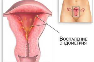 Метроэндометрит: причини виникнення та основні симптоми, способи лікування захворювання