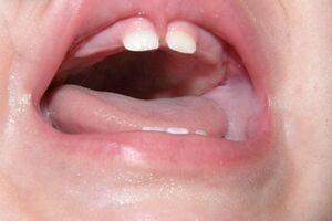 Короткая уздечка губы: причины возникновения и основные симптомы, способы лечения заболевания