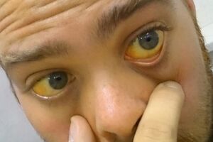 Механическая желтуха: причини виникнення та основні симптоми, способи лікування захворювання