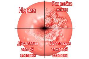 Рак шейки матки: причины возникновения и основные симптомы, способы лечения заболевания