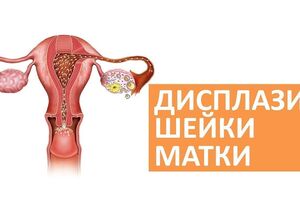 Дисплазия шейки матки: причини виникнення та основні симптоми, способи лікування захворювання