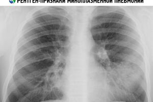 Микоплазменная пневмония: причини виникнення та основні симптоми, способи лікування захворювання
