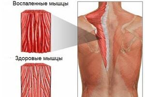 Миозит мышц спины: причины возникновения и основные симптомы, способы лечения заболевания