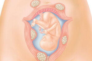 Миома матки при беременности: причины возникновения и основные симптомы, способы лечения заболевания