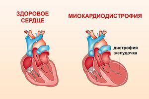 Миокардиодистрофия: причины возникновения и основные симптомы, способы лечения заболевания