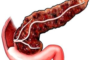 Медикаментозный панкреатит: причины возникновения и основные симптомы, способы лечения заболевания
