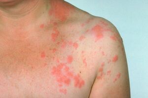 Медикаментозный дерматит: причини виникнення та основні симптоми, способи лікування захворювання