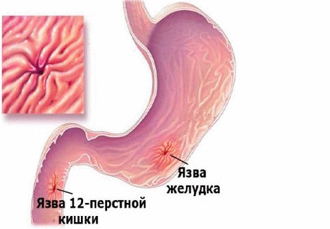 Медикаментозная язва желудка: причины возникновения и основные симптомы, способы лечения заболевания