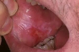 Красный плоский лишай полости рта: причини виникнення та основні симптоми, способи лікування захворювання