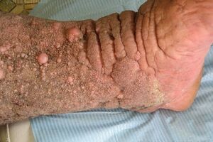 Карциноидный папилломатоз кожи Готтрона: причини виникнення та основні симптоми, способи лікування захворювання