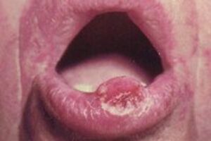 Кератоакантома губ и слизистой рта: причины возникновения и основные симптомы, способы лечения заболевания