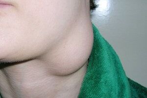 Киста шеи: причины возникновения и основные симптомы, способы лечения заболевания