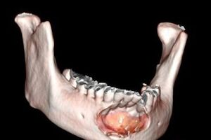Кисты челюстные: причини виникнення та основні симптоми, способи лікування захворювання
