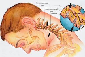 Межпозвоночная грыжа шейного отдела: причины возникновения и основные симптомы, способы лечения заболевания