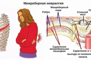 межреберный остеохондроз симптомы и лечение всё