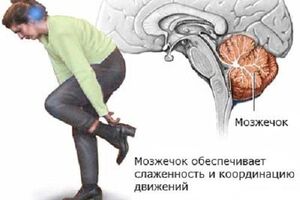 Мозжечковая атаксия: причини виникнення та основні симптоми, способи лікування захворювання