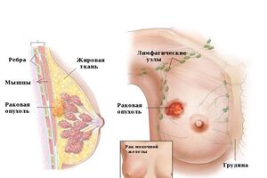 Наследственный рак молочной железы: причины возникновения и основные симптомы, способы лечения заболевания