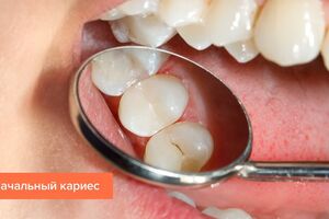 Начальный кариес: причины возникновения и основные симптомы, способы лечения заболевания