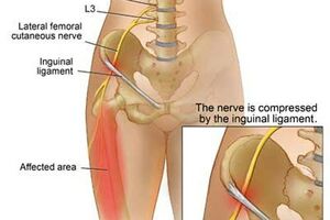 Невропатия бедренного нерва: причины возникновения и основные симптомы, способы лечения заболевания