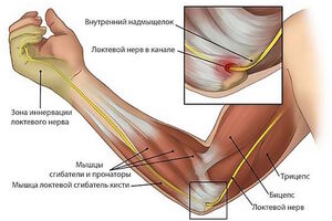 Невропатия локтевого нерва: причины возникновения и основные симптомы, способы лечения заболевания