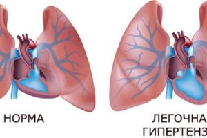 Лёгочная гипертензия: причины возникновения и основные симптомы, способы лечения заболевания