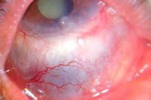 Бруцеллез глаз: причины возникновения и основные симптомы, способы лечения заболевания