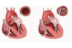 Недостаточность клапана легочной артерии: причины возникновения и основные симптомы, способы лечения заболевания