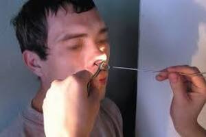 Кровоточащий полип перегородки носа: причины возникновения и основные симптомы, способы лечения заболевания