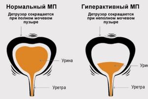 Нейрогенный мочевой пузырь: причини виникнення та основні симптоми, способи лікування захворювання