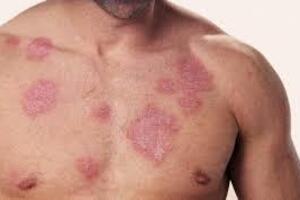Лихеноидный туберкулез кожи: причини виникнення та основні симптоми, способи лікування захворювання