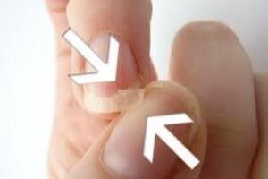 Ломкие ногти: причини виникнення та основні симптоми, способи лікування захворювання