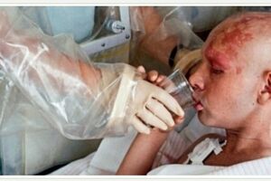 Лучевая болезнь: причины возникновения и основные симптомы, способы лечения заболевания