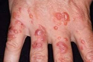 Лучевой дерматит: причины возникновения и основные симптомы, способы лечения заболевания
